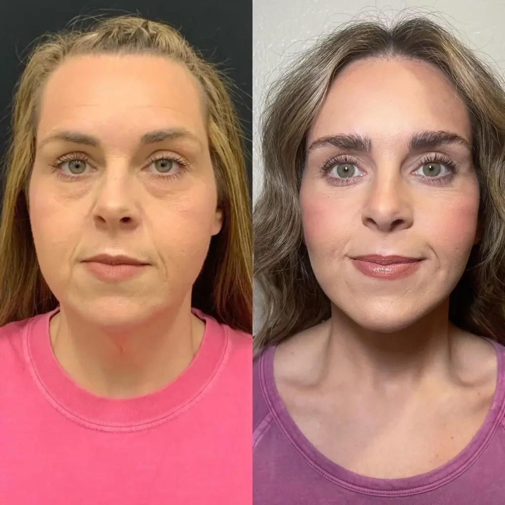 Buccal Fat Removal Before and After