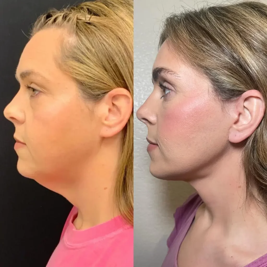 Buccal Fat Removal Before and After