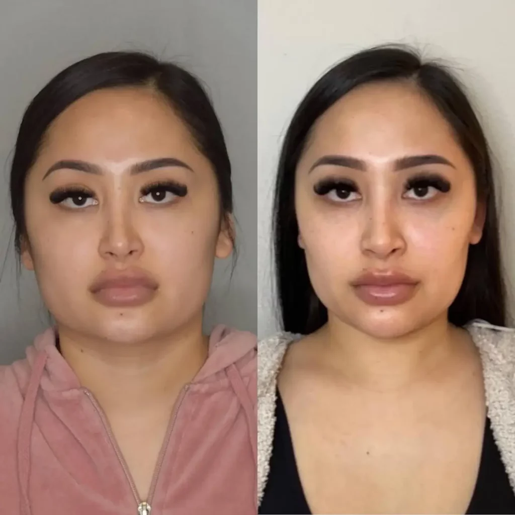 Buccal Fat Removal Before and After