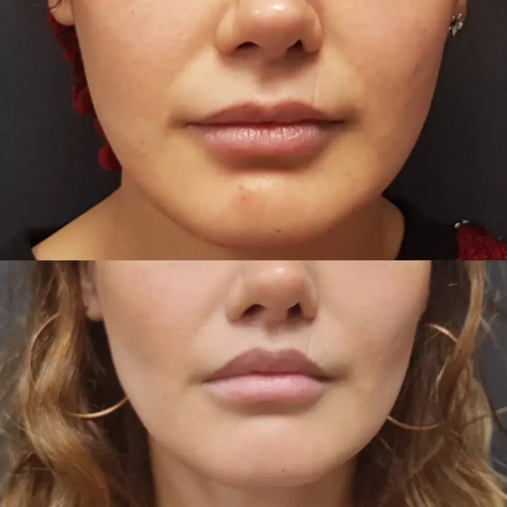 Buccal Fat Removal Before and After