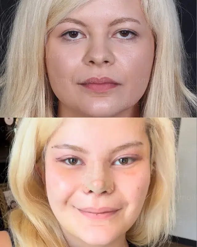 Buccal Fat Removal Before and After