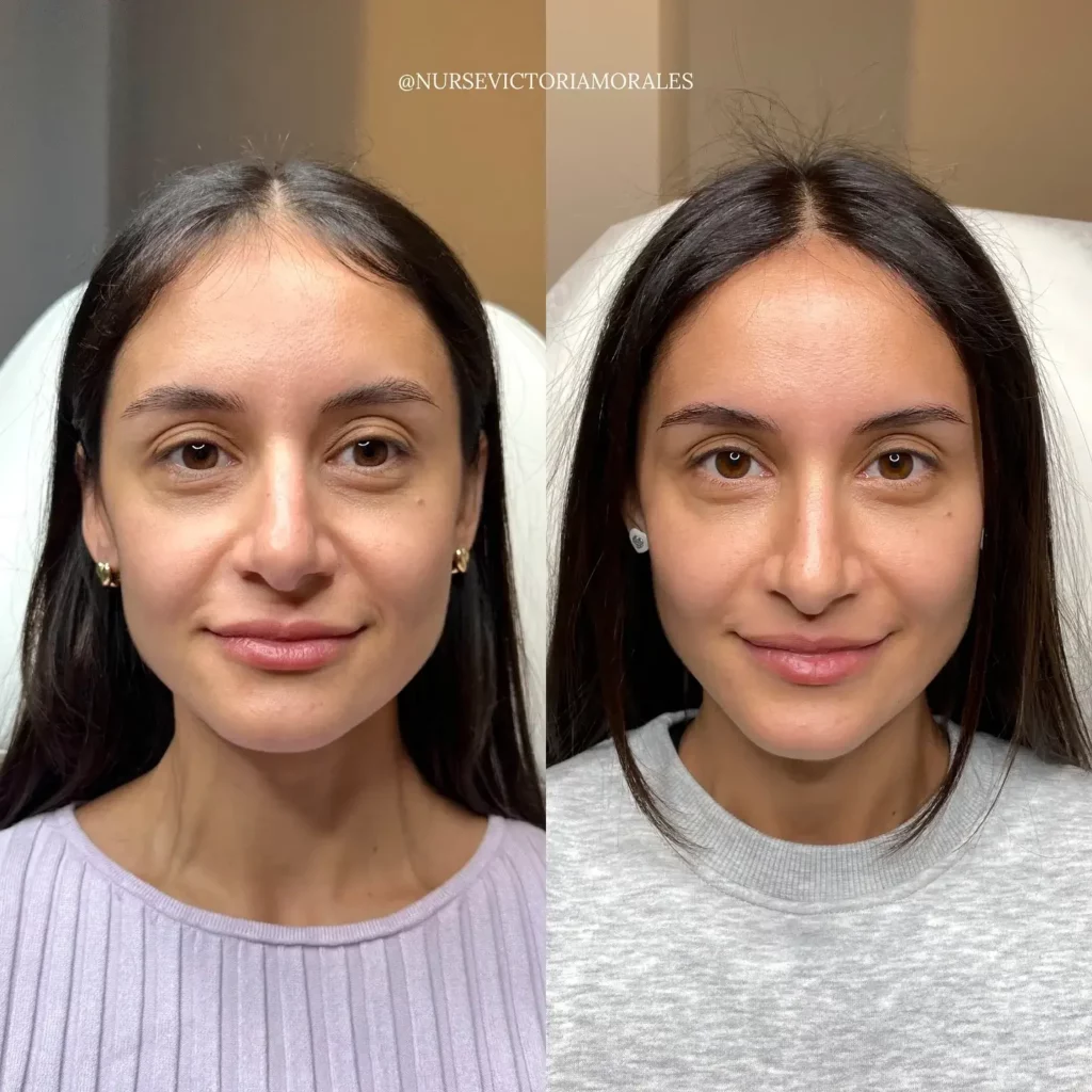 Cheek Filler Before and After