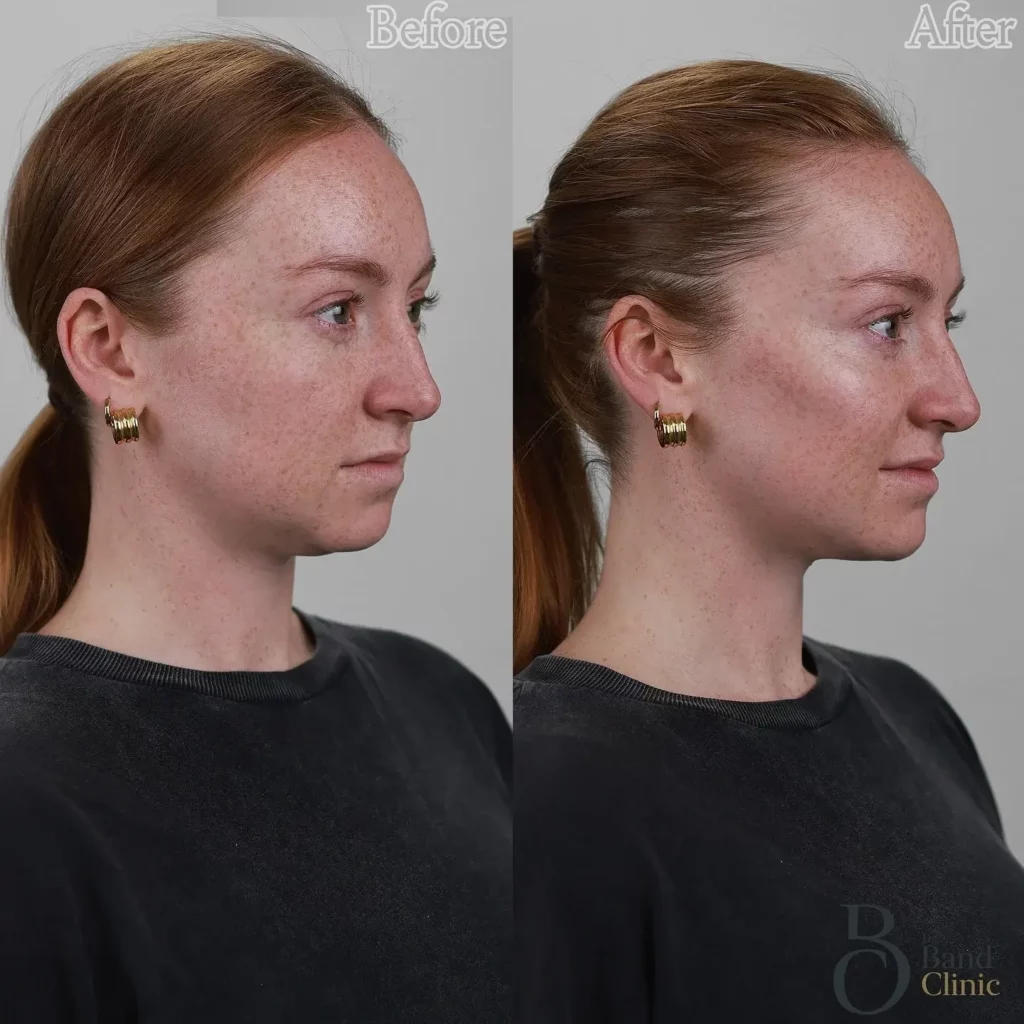 Cheek Filler Before and After