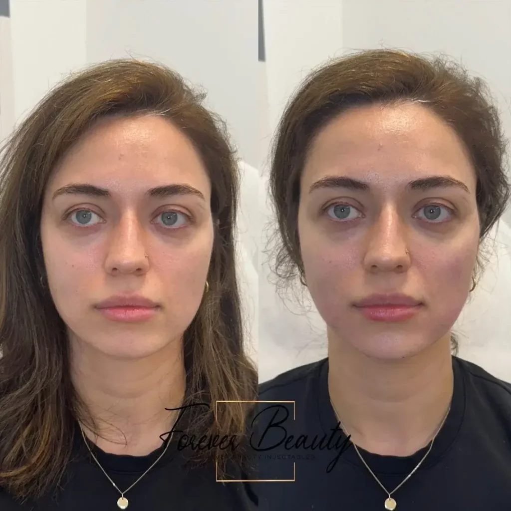 Cheek Filler Before and After