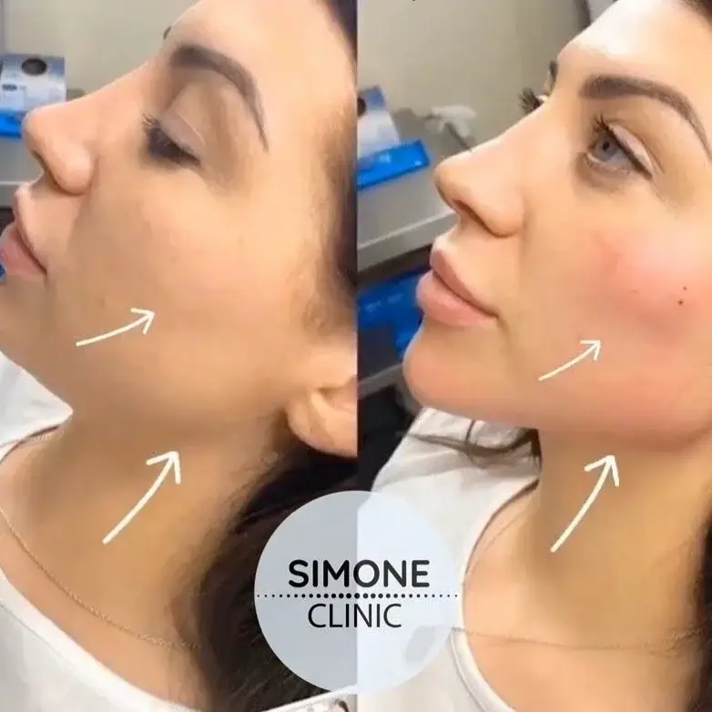 Cheek Filler Before and After