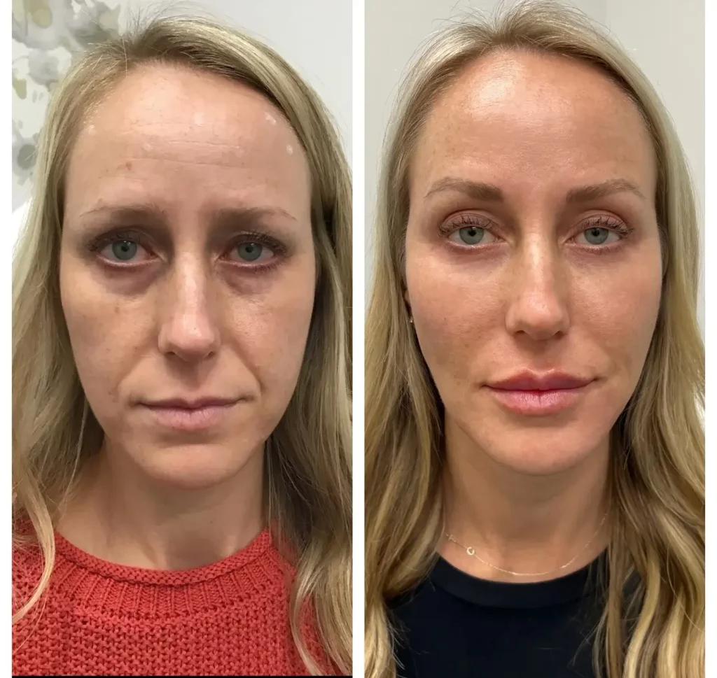 Cheek Filler Before and After