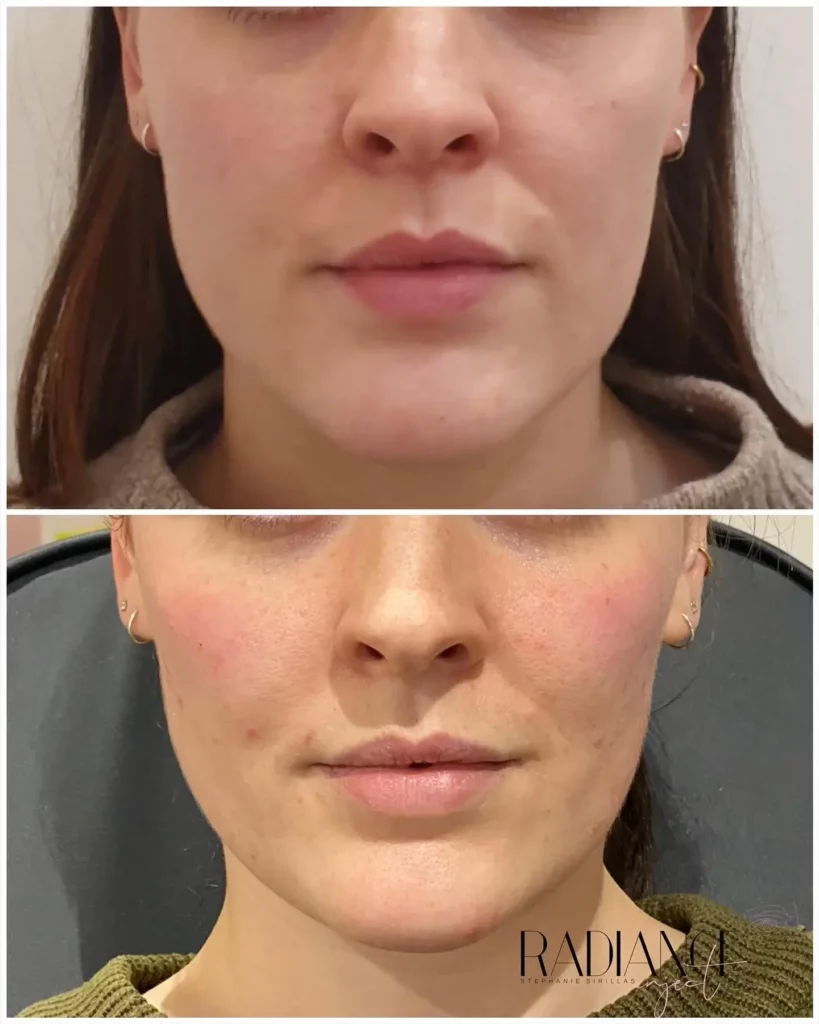 Cheek Filler Before and After