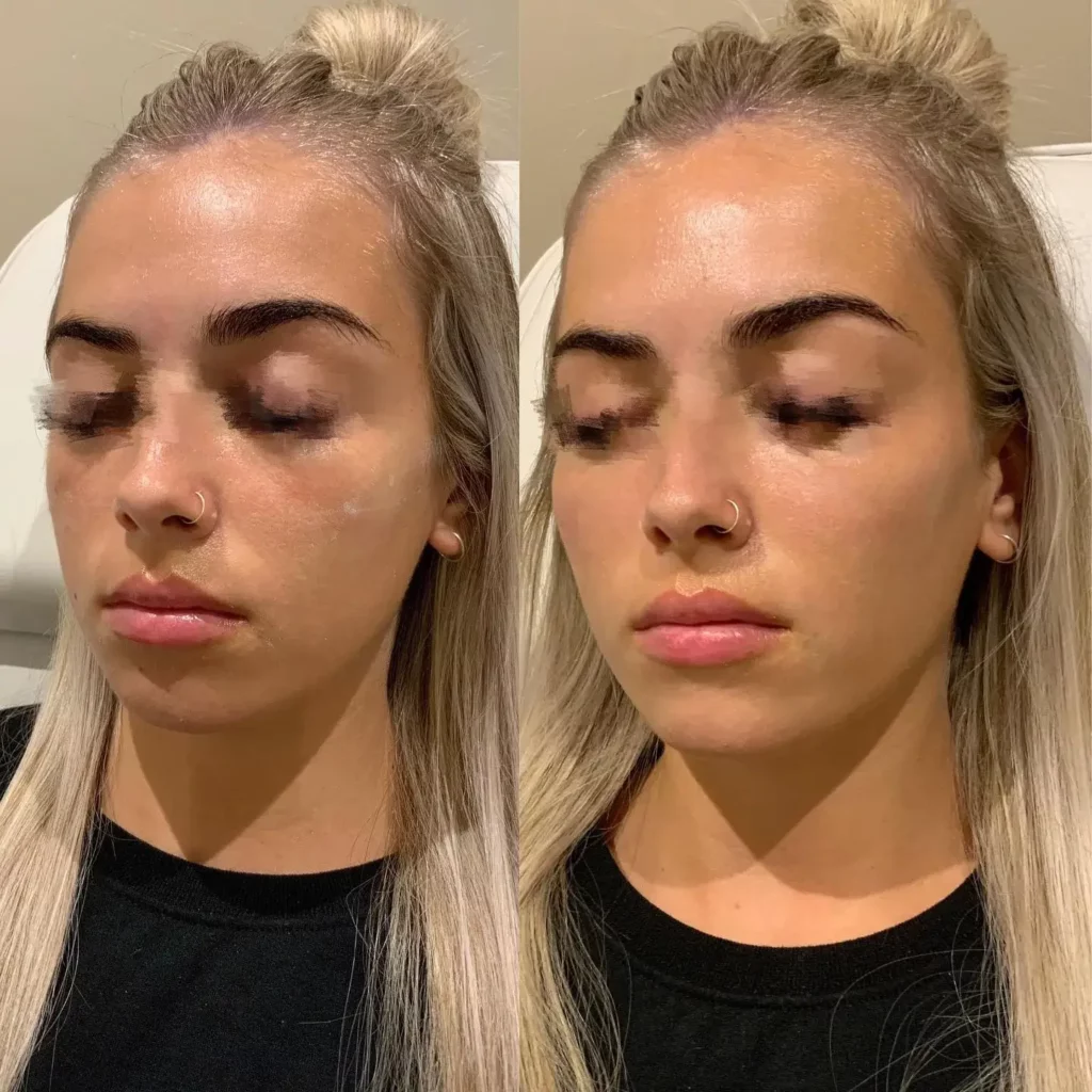 Cheek Filler Before and After