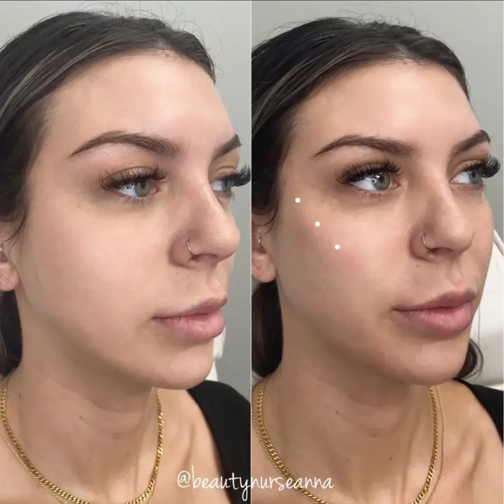 Cheek Filler Before and After