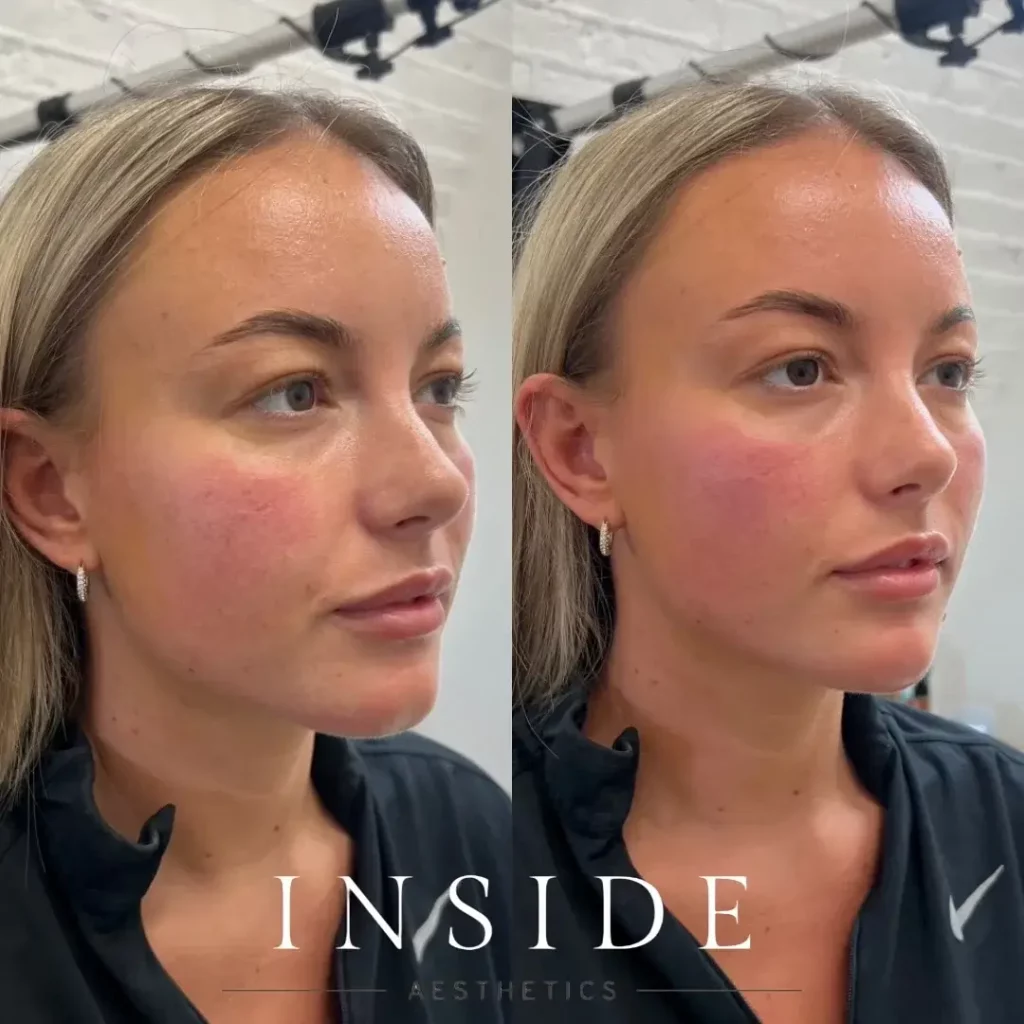 Cheek Filler Before and After