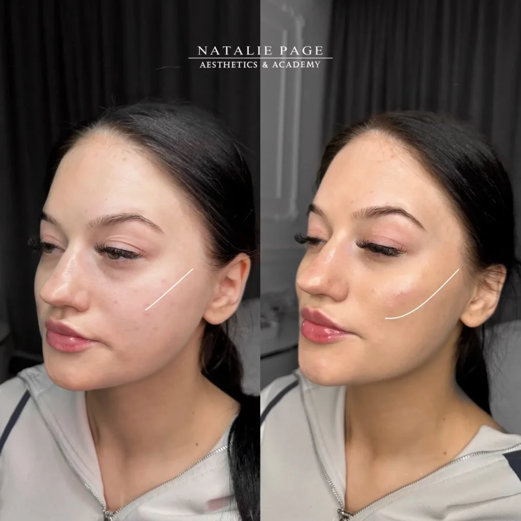 Cheek Filler Before and After