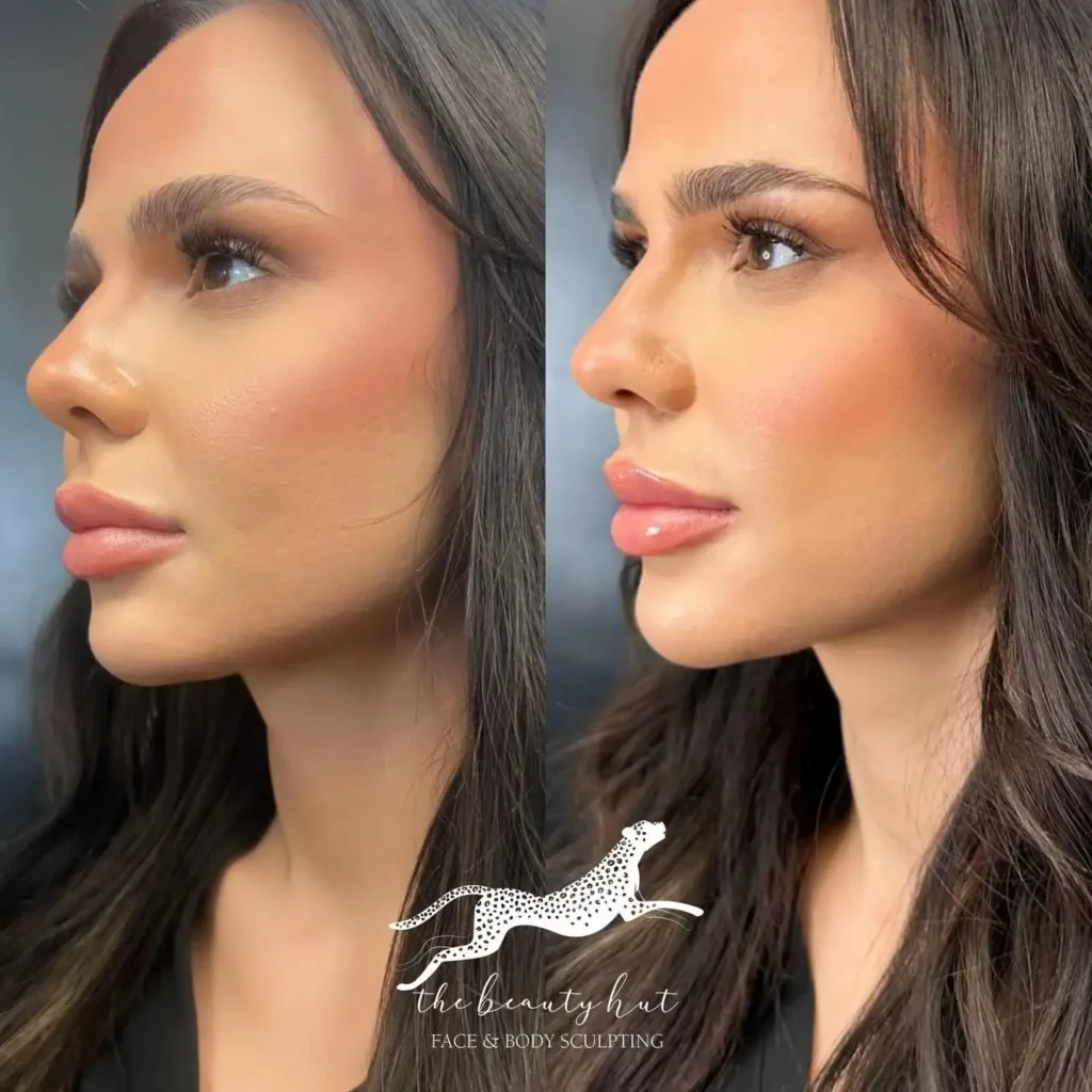 Cheek Filler Before and After