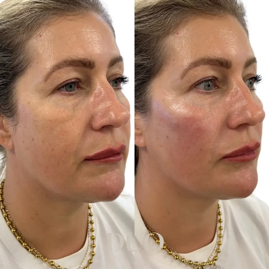 Cheek Filler Before and After