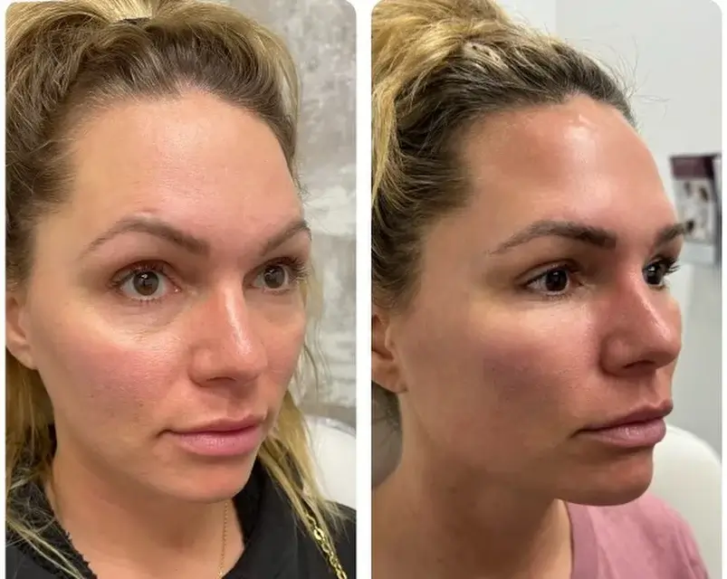 Cheek Filler Before and After