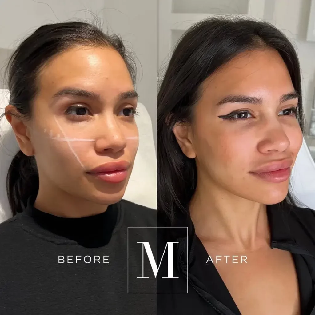 Cheek Filler Before and After