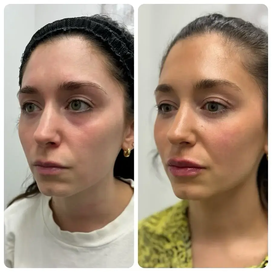 Cheek Filler Before and After