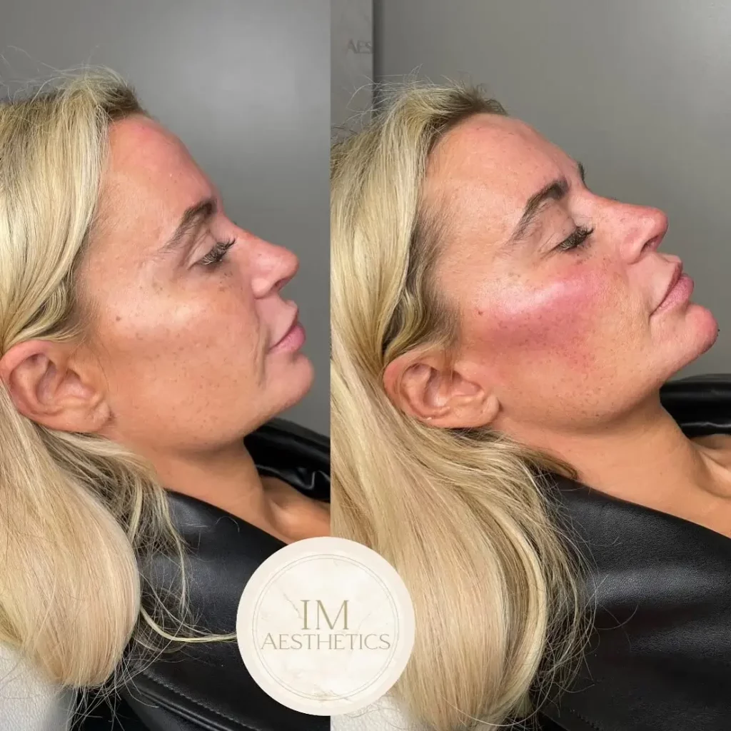 Cheek Filler Before and After