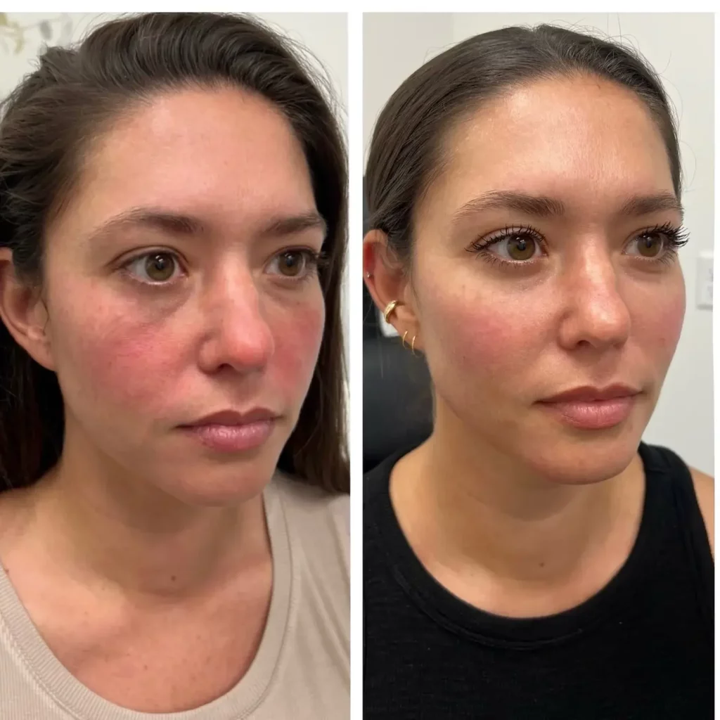 Cheek Filler Before and After