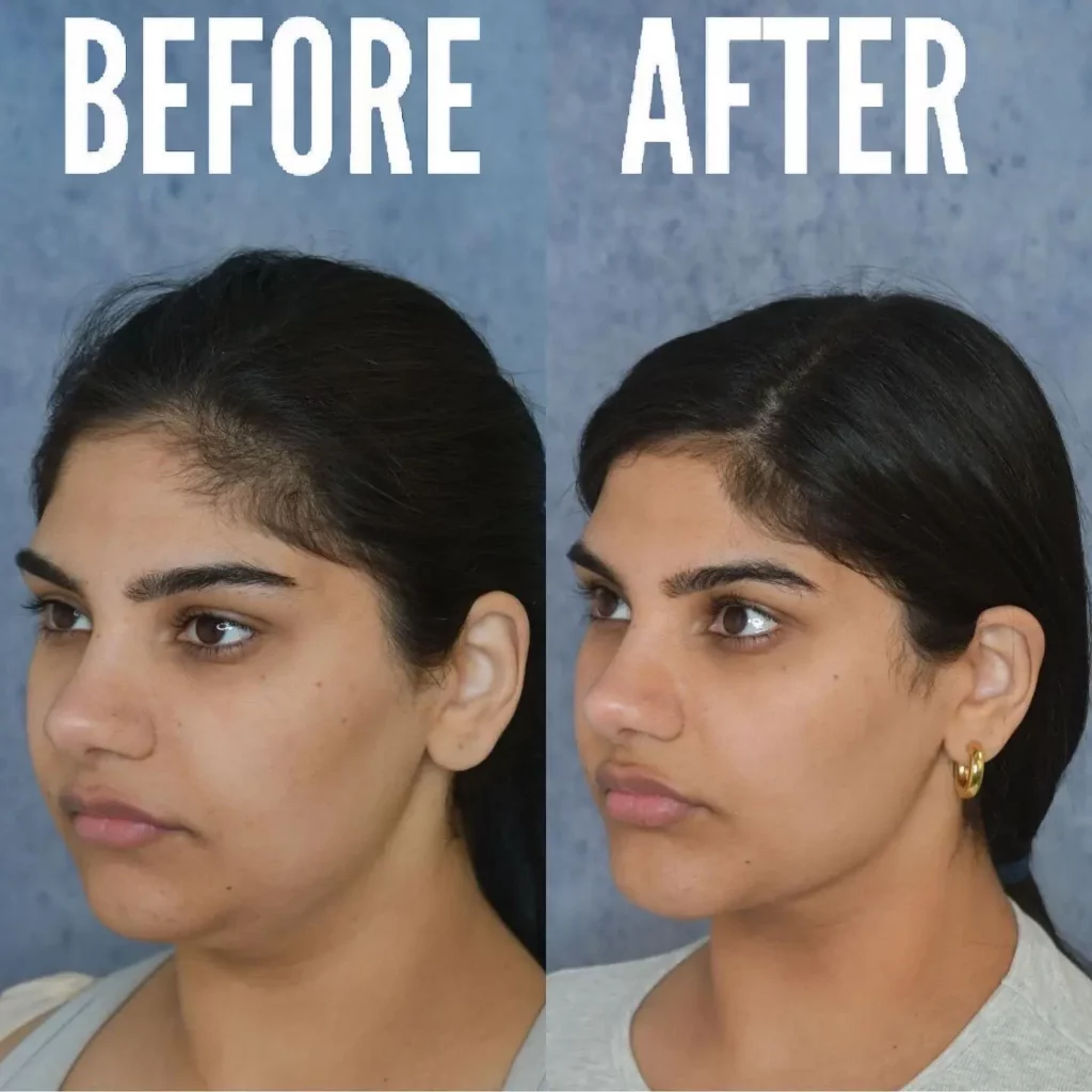 Chin Implant Before and After