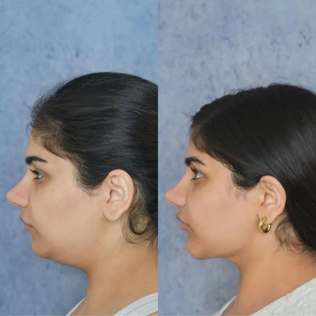 Chin Implant Before and After