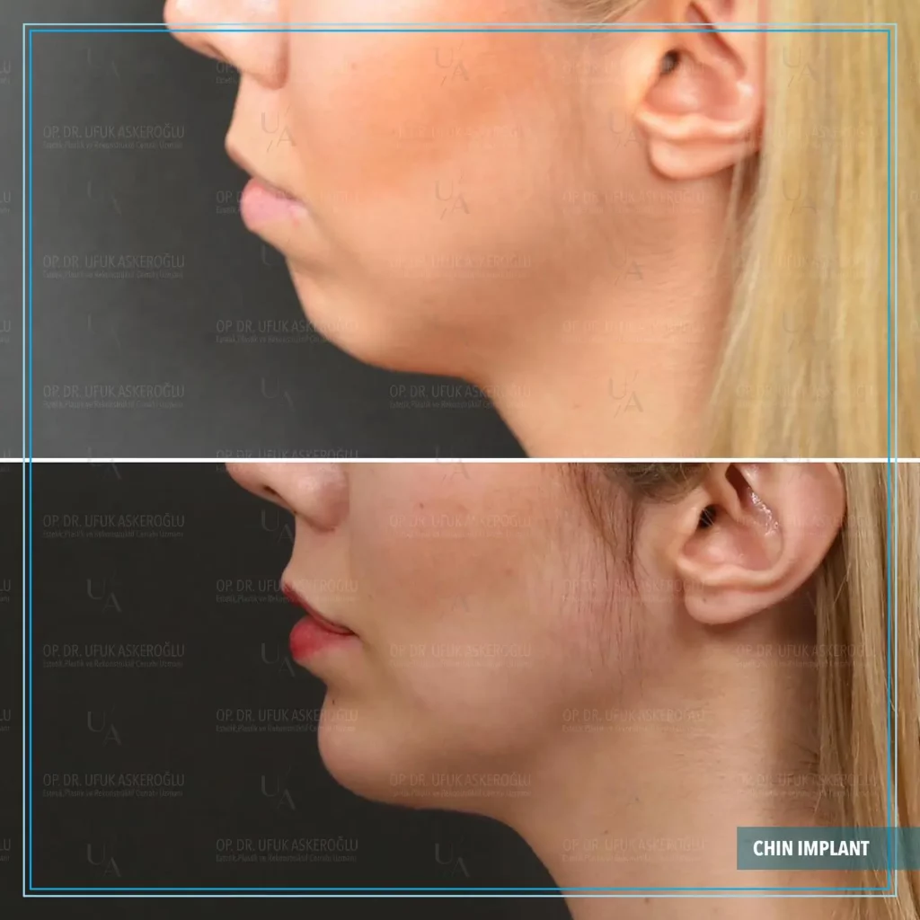 Chin Implant Before and After