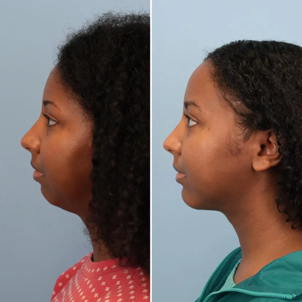 Chin Implant Before and After