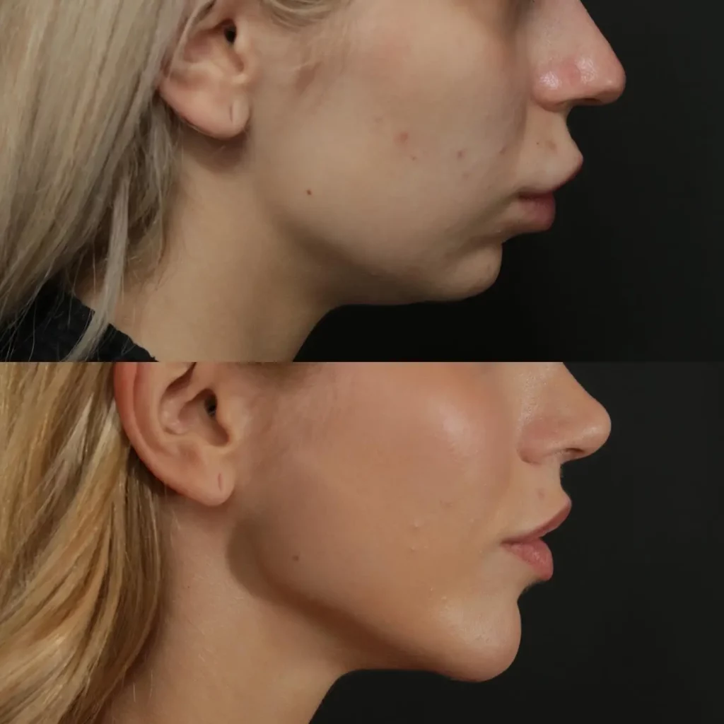 Chin Implant Before and After