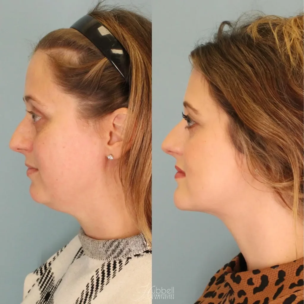 Chin Implant Before and After