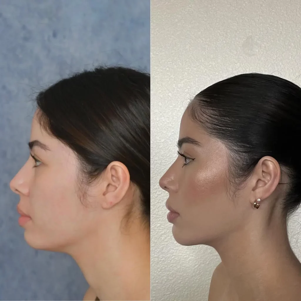 Chin Implant Before and After