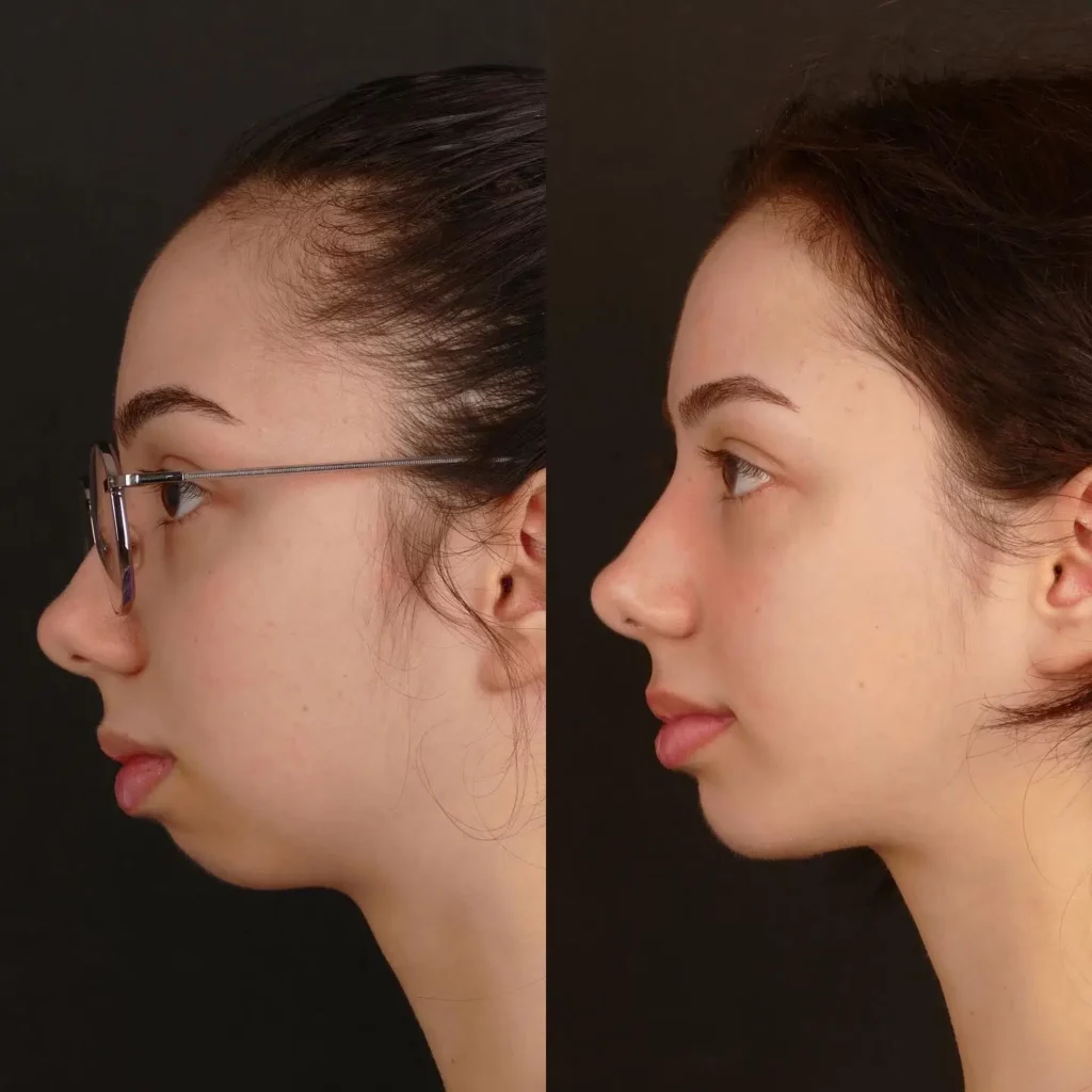 Chin Implant Before and After