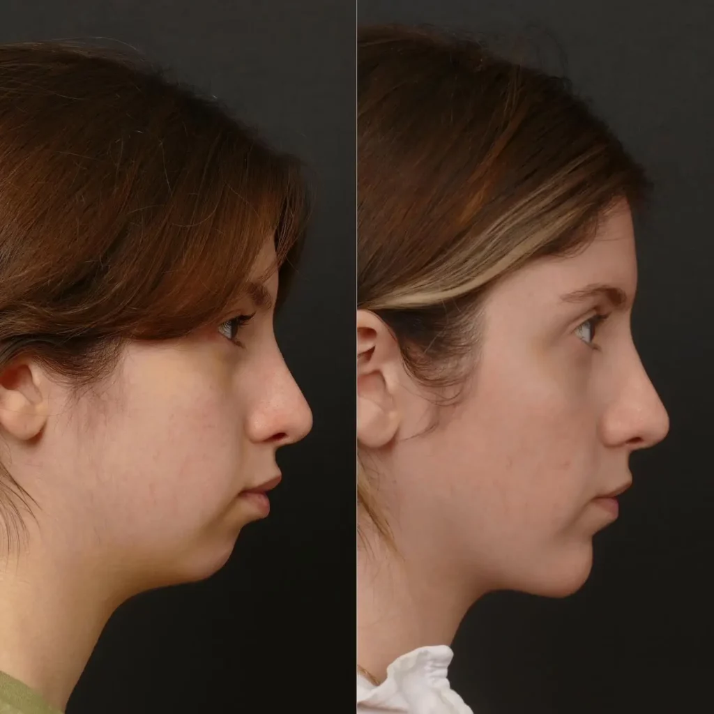 Chin Implant Before and After