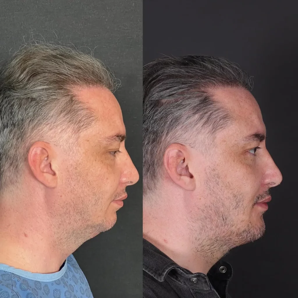 Chin Implant Before and After