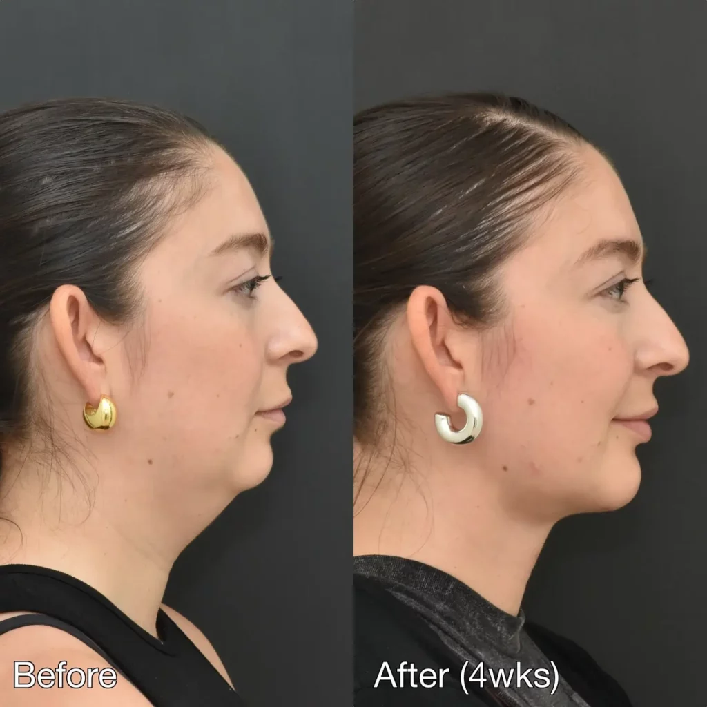 Chin Implant Before and After