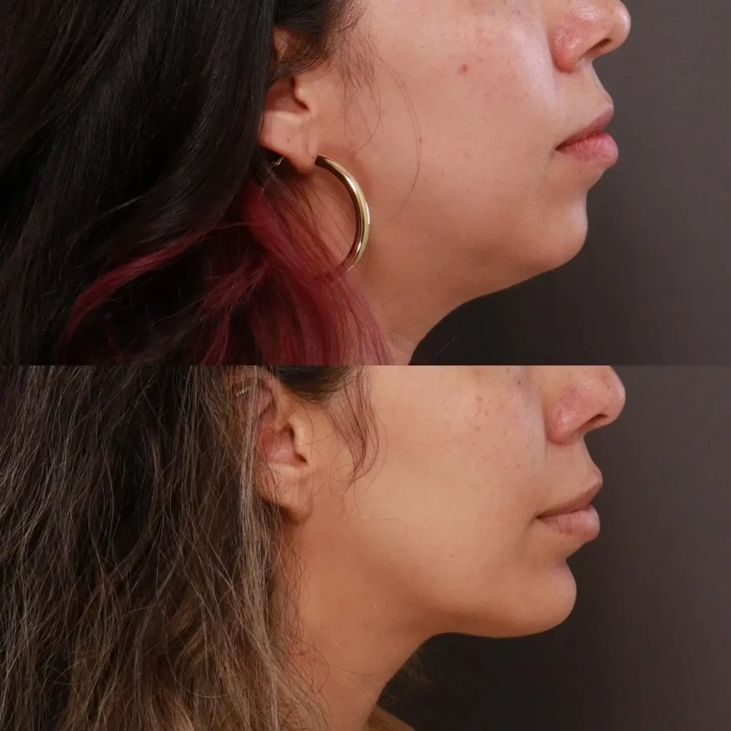 Chin Implant Before and After