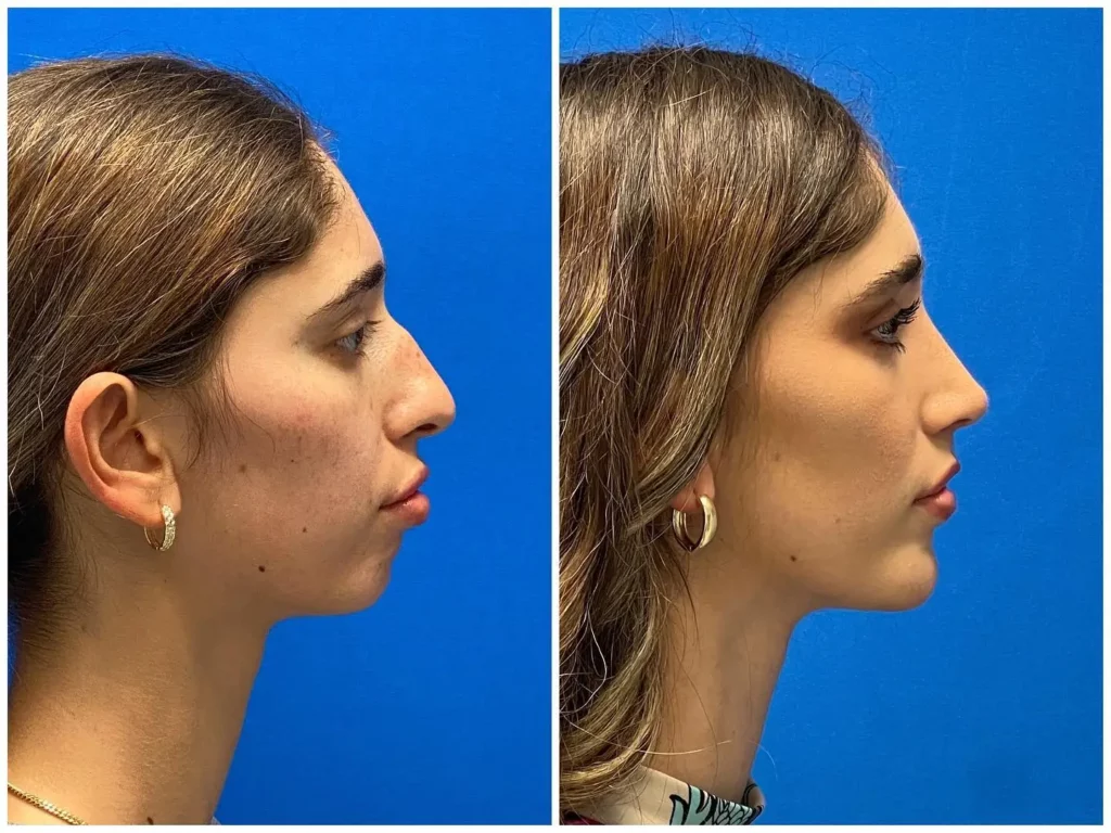 Chin Implant Before and After