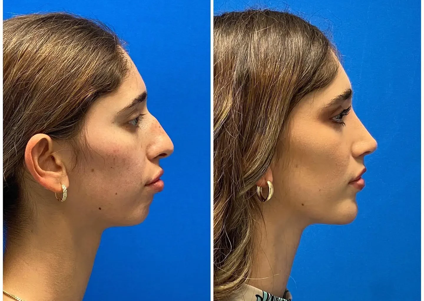 Chin Implant Before and After