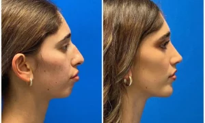 Chin Implant Before and After