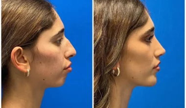 Chin Implant Before and After