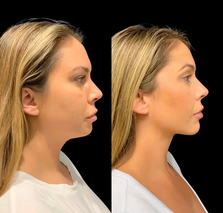 Chin Implant Before and After