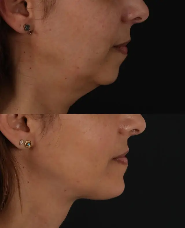 Chin Implant Before and After