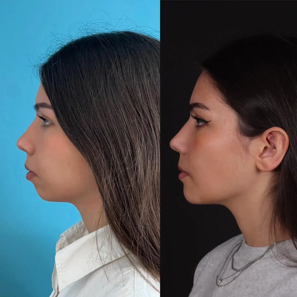 Chin Implant Before and After