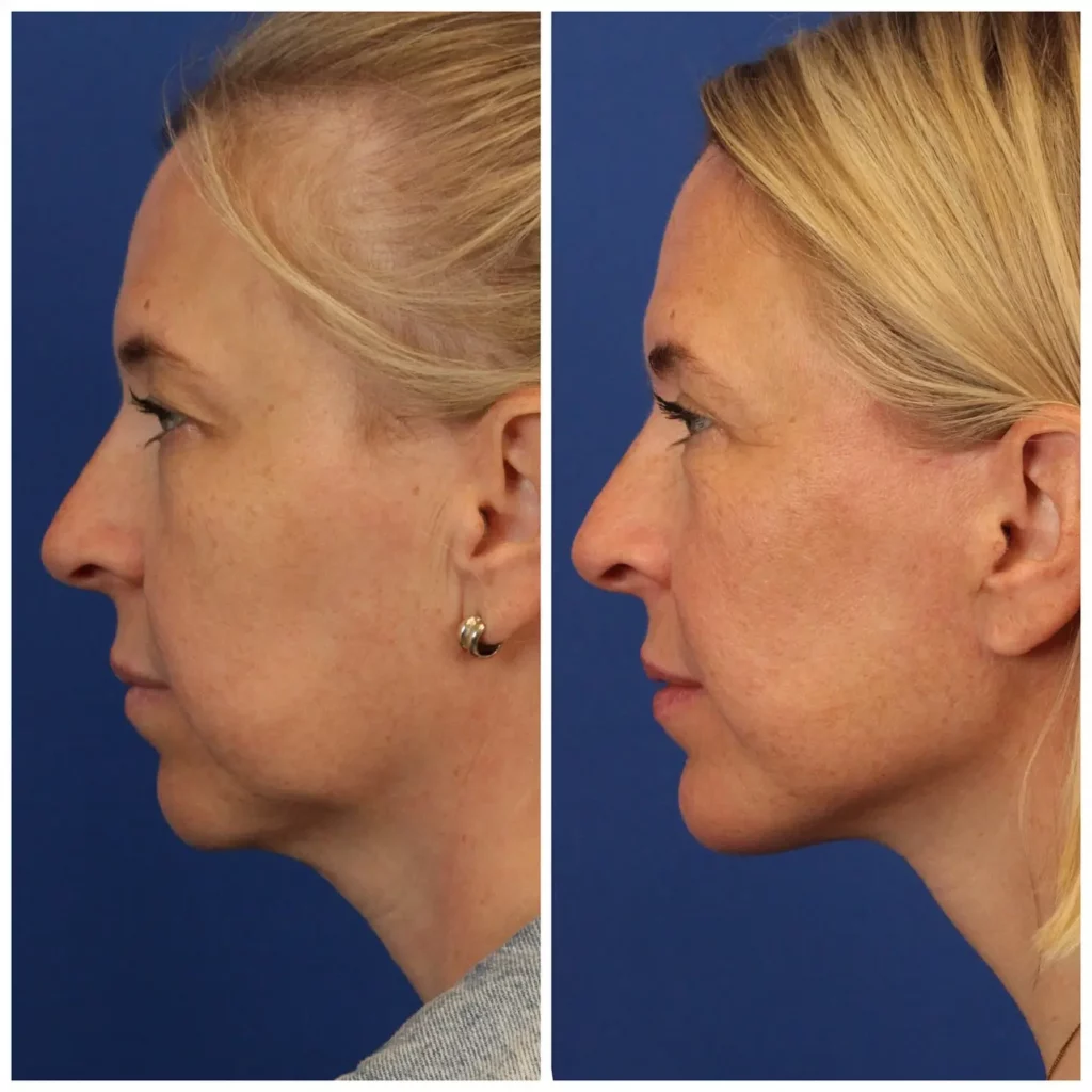 Chin Implant Before and After