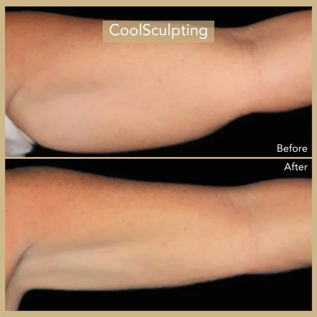 CoolSculpting Before and After