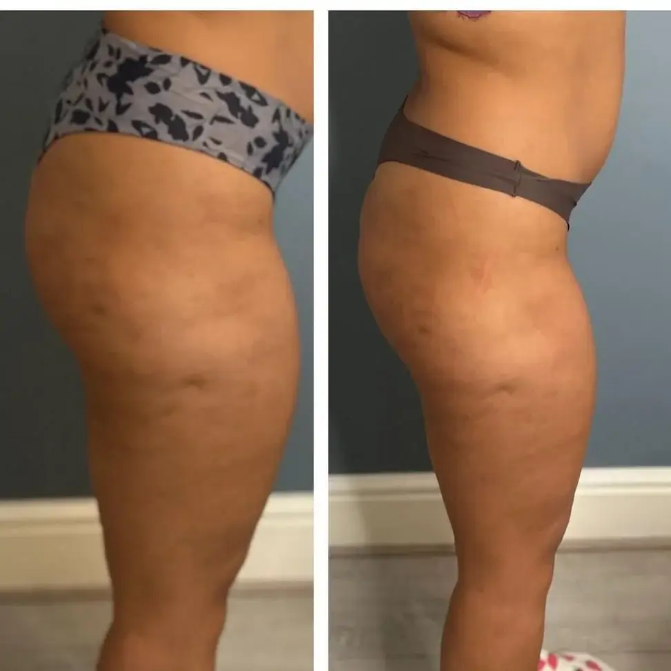 CoolSculpting Before and After