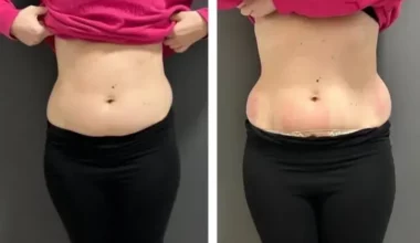 CoolSculpting Before and After