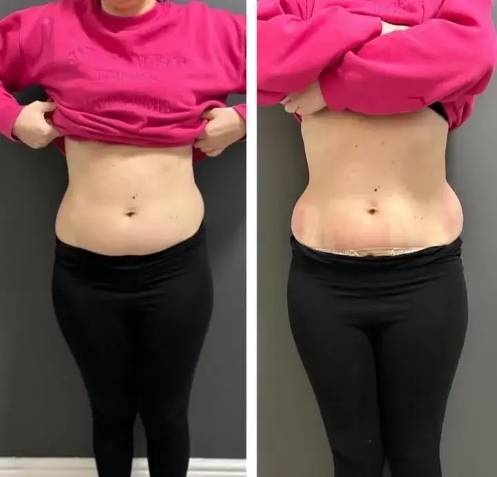 CoolSculpting Before and After