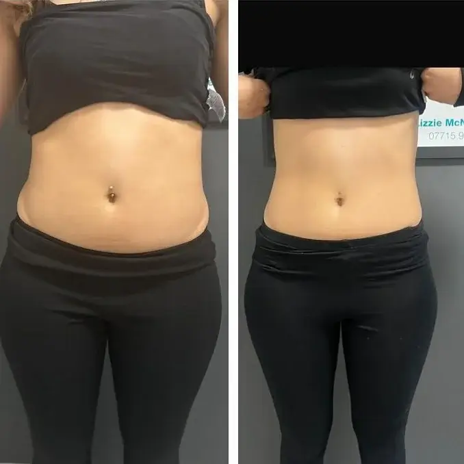 CoolSculpting Before and After