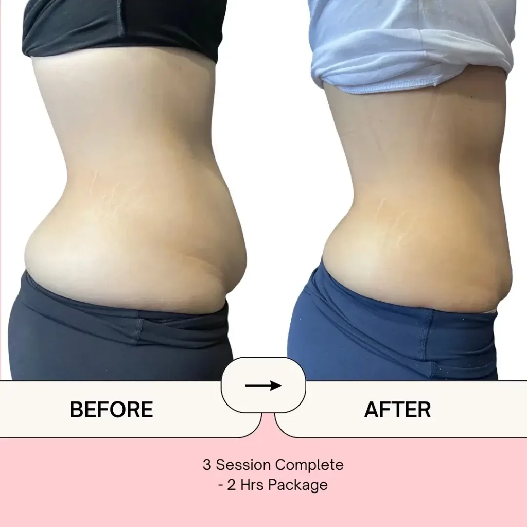 CoolSculpting Before and After