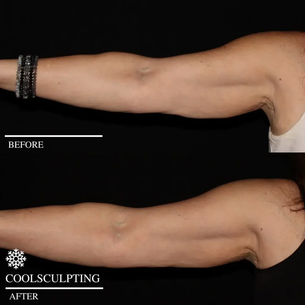 CoolSculpting Before and After