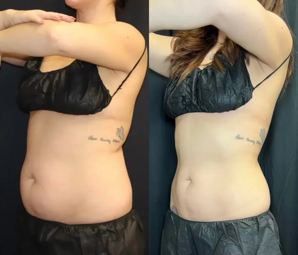 CoolSculpting Before and After